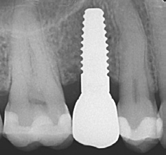 Abb. 25a: Implantat 15; 6 Monate post Loading.