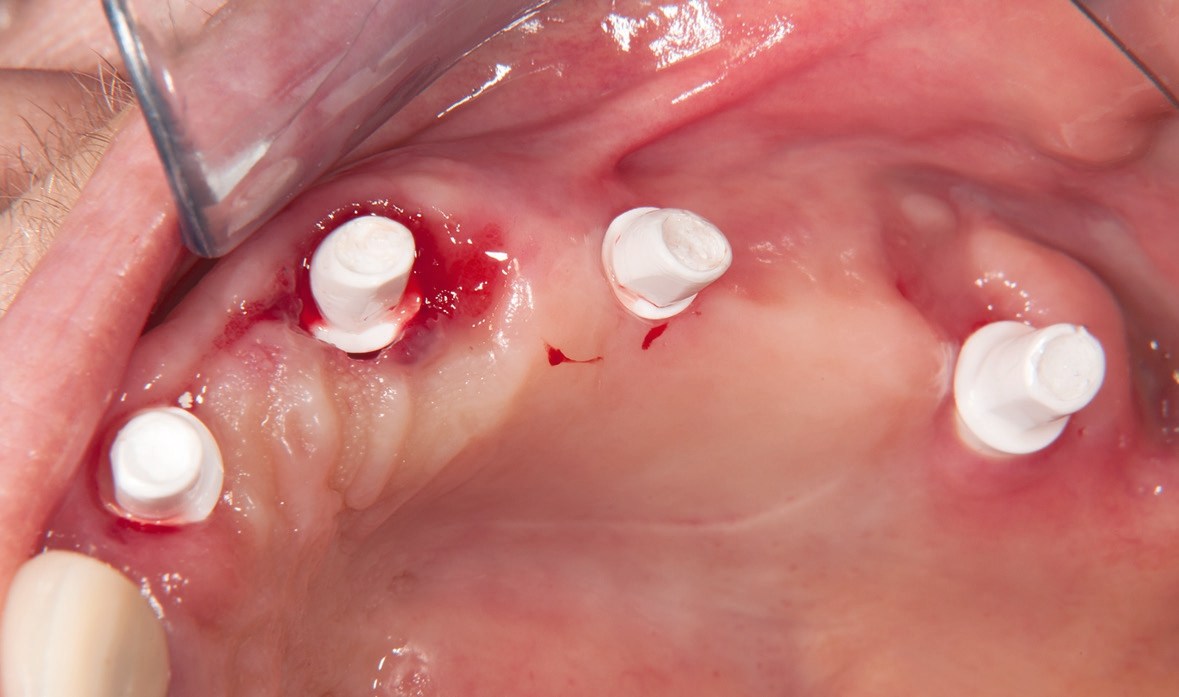 Abb. 25: Aufgesetzte Abutments, mit 15 N/cm verschraubt und mit Teflonband abgedeckt.