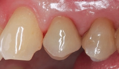 Abb. 25: Ansicht von bukkal nach 3 Monaten: Die Gingiva zeigt sich reizlos, die Patientin war mit der gewählten Therapieform ästhetisch und funktionell sehr zufrieden.