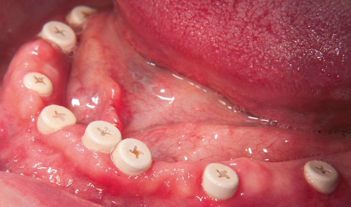 Abb. 25: Gingivale Situation vor Inkorporation der Brücken.