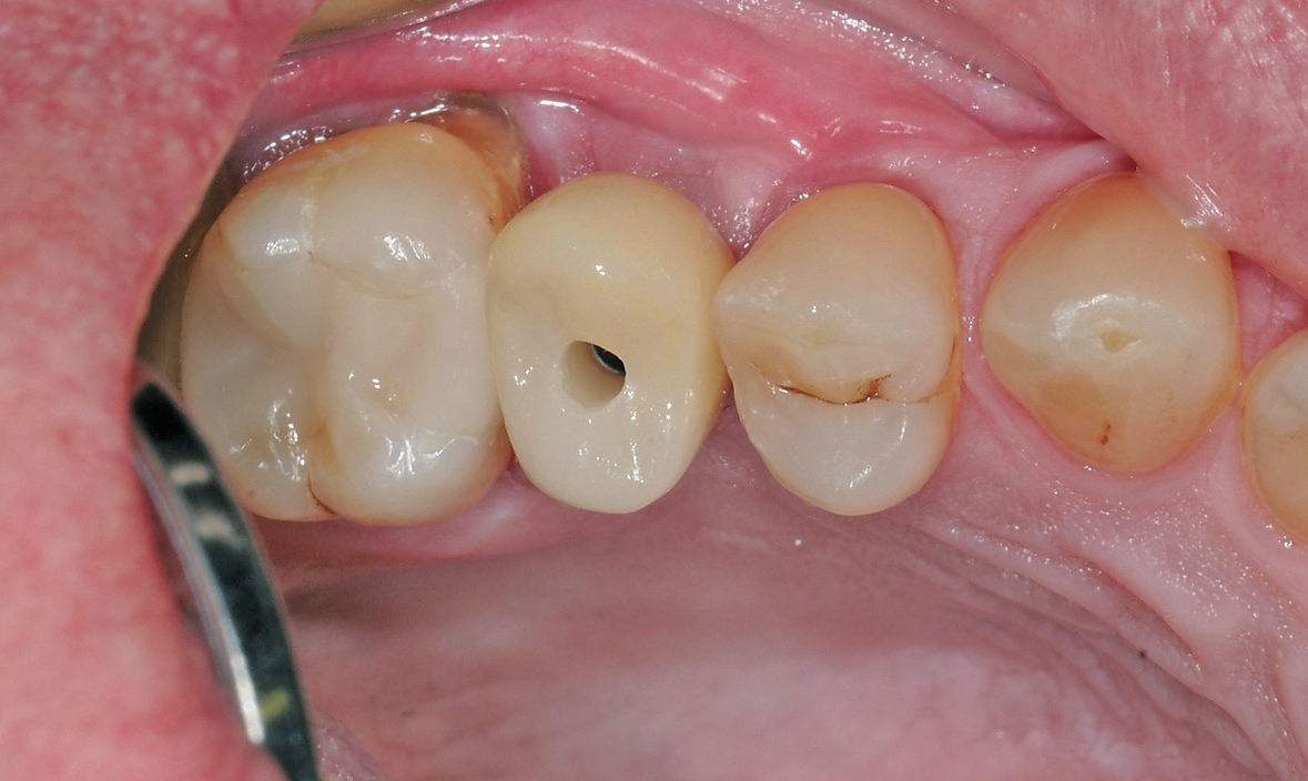 Abb. 24: Auf das Implantat „geklopfte“ Krone. Die Morse-Taper-Verbindung sorgt für Selbsthemmung zwischen Implantat und Abutment.
