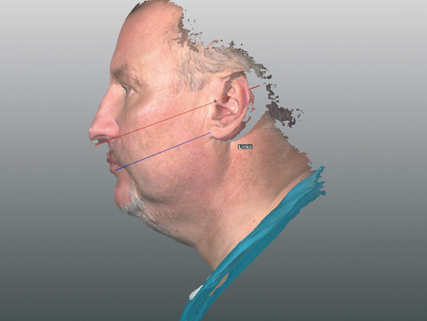 Abb. 18b: … anhand der Ala-Tragus-Linie.