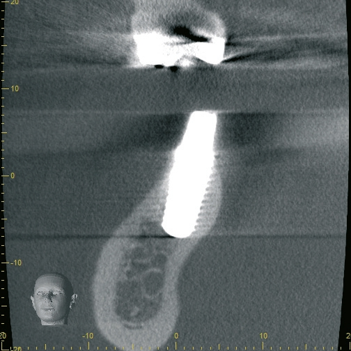Abb. 25: Die Implantatposition im CT von sagittal.