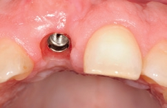 Abb. 24: Einen Monat später wird der Gingivaformer entfernt und es erfolgt die Erstabformung mit einem konfektionierten Standardtransferpfosten und einem individuellen Löffel für die Anfertigung eines laborgefertigten Langzeitprovisoriums.