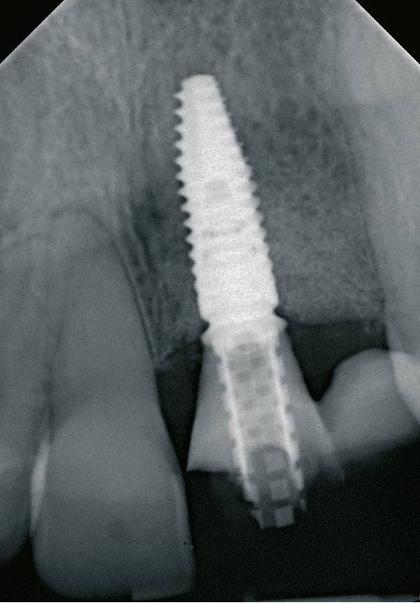 Abb. 24: Das Röntgenbild zeigt den guten Sitz von Implantat und Provisorium.