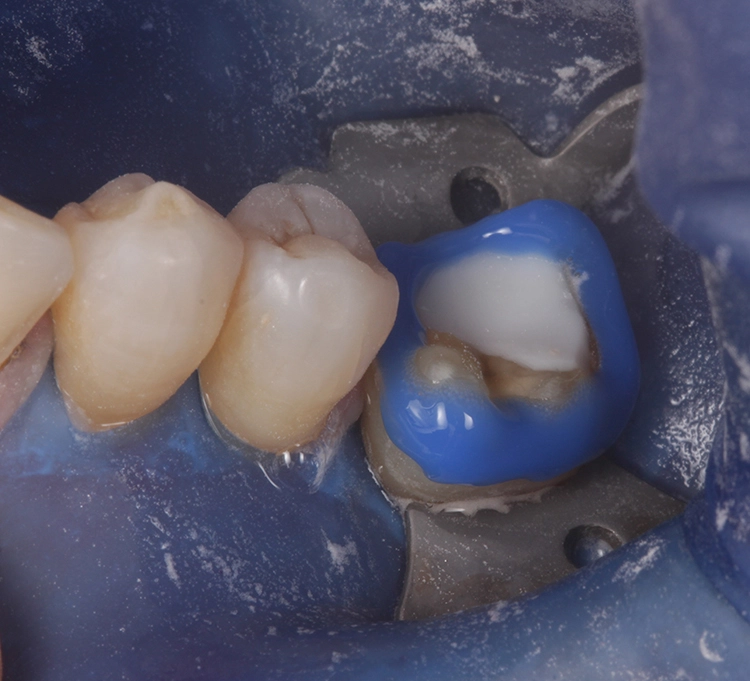 Abb. 25 und Abb. 25a: Eingliederung der definitiven Versorgung im UK. Selektive Eingliederung der zuvor geätzten und silanisierten Empress Teilkronen und Veneers mit Syntac Classic und Variolink Esthetic (Ivoclar, Liechtenstein) nach vorherigem Abstrahlen der präparierten Zahnoberflächen (Rondoflex plus, Kavo) mit Aluminiumoxidpulver der Korngrösse 27 ?m (Rondoflex plus, Kavo) und Schmelzätzung mit 35 % Phosphorsäure (Ultraetch, Ultradent).