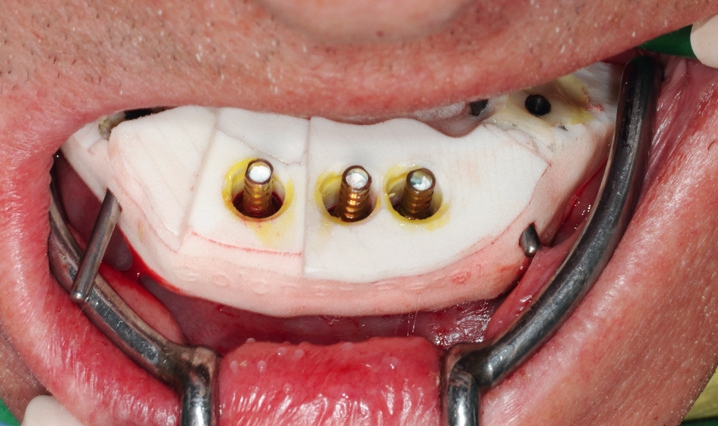 Abb. 25: Insert, aus dem die Bohrhülsen entfernt wurden und das nun mit der Basisschablone versplintet als Individueller Abdrucklöffel fungiert.