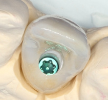 Abb. 25: Optimal positioniertes Implantat für die direkte Verschraubung der Hybridabutmentkrone.