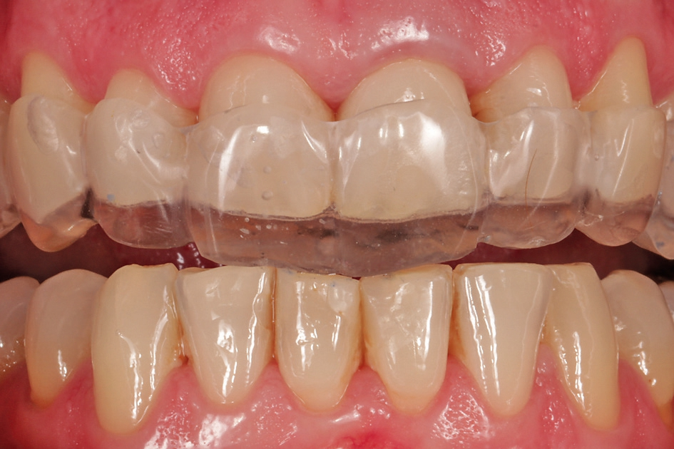 Abb. 38: Kontrolle der Schienenprotrusion.