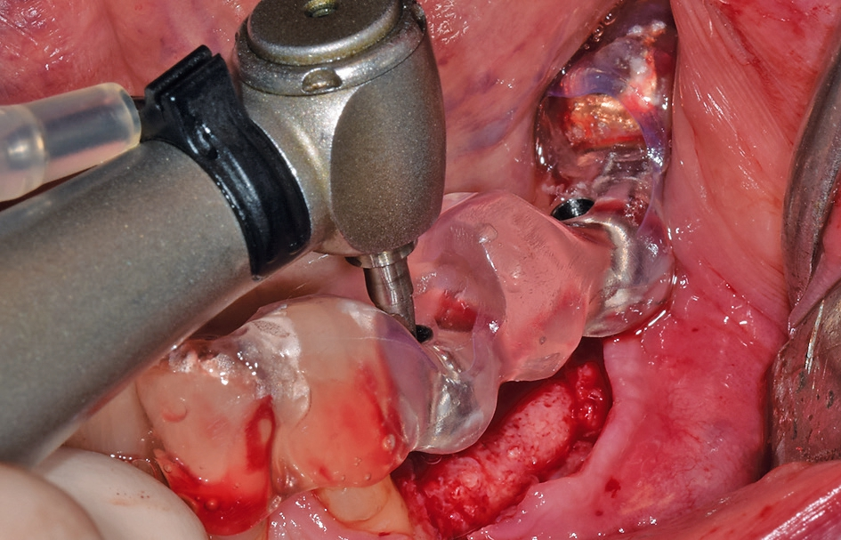 Abb. 62: Implantation mit Bohrschablone; nicht full guided.