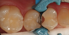 Abb. 25: Die nun vollständig exkavierten Kavitäten – bereits mit Teilmatrizen und einem Palodent V3-Spannring isoliert.