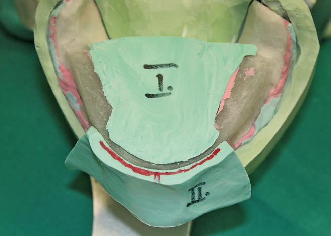 Abb. 20: Zungen- und Frontkonter auf dem Modell.