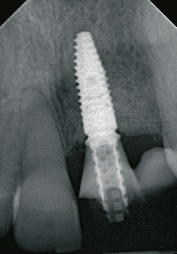Abb. 24: Das Röntgenbild zeigt den guten Sitz von Implantat und Provisorium.