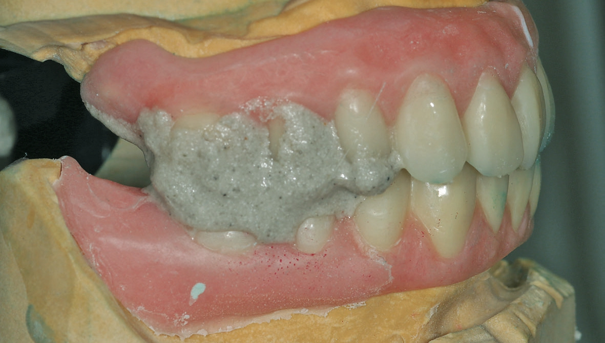 Abb. 32: Die Laterotrusion, Protrusion und Retrusion werden auf dem Rüttler mit Bimssteinpulver zwischen den Zahnreihen noch einmal nachgefahren. Da der OK mit Gesichtsbogen in den Artikulator übertragen wurde, erreicht man somit ein ganz harmonisches Gleiten des UK nach allen Richtungen.