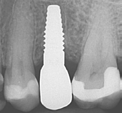 Abb. 25a: Implantat 25; 6 Monate post Loading.