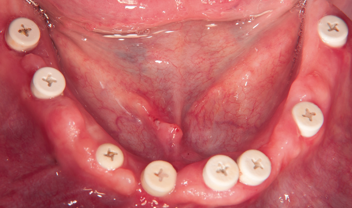 Abb. 26: Gingivale Situation vor Inkorporation der Brücken von okklusal.