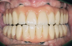 Abb. 26: Abschlusssituation intraoral, Spalt zum Kieferkamm nun geschlossen.