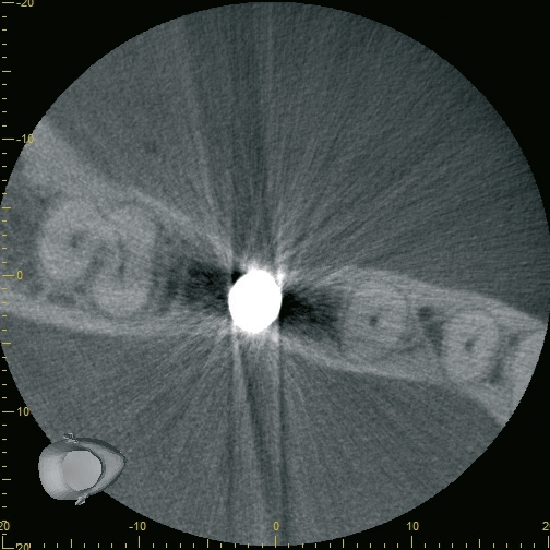Abb. 26: Die Implantatposition im CT von okklusal.