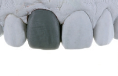 Abb. 25: Diagnostisches Wax-up auf dem Gipsmodell der Implantaterstabformung.