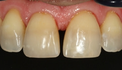 Abb. 26: Lückenreduktion aus Kombination der Dentinfarbe (palatinal) und der Universalfarbe (labial), Situation nach 1 Jahr (nach PZR).