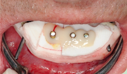 Abb. 26: Prothetikkappen mit Insert, das die Bohrhülsen enthielt, mit Qu-Resin verblockt und mit der Basisschablone versplintet.