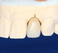 Abb. 26: Um die Interdentalpapillen zu erhalten, wurden die Kontaktpunkte den Tarnow-Regeln folgend 4 mm oberhalb des Knochens angelegt.
