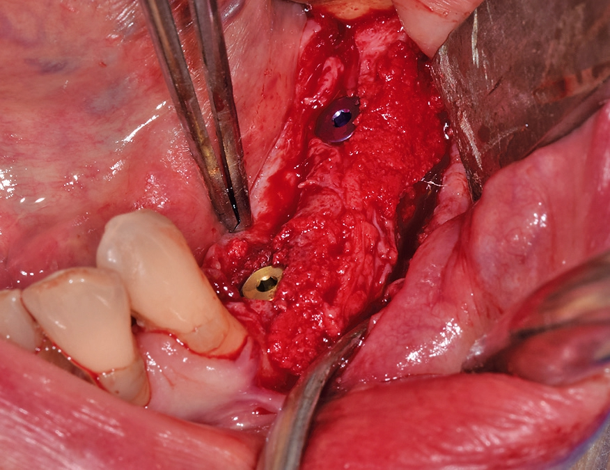 Abb. 63: Implantation mit Bohrschablone; nicht full guided.