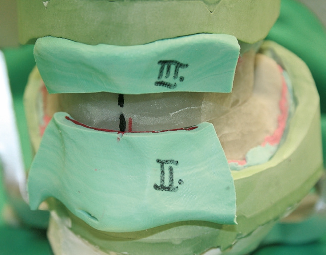 Abb. 21: Front- und Halskonter von lingual.