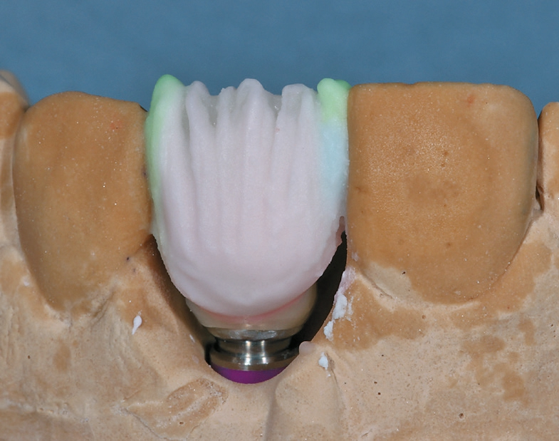 Abb. 24: Mesial und distal werden transparente Randleisten angelegt.