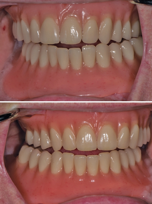 Abb. 30 u. 31: Kontrolle der Exzentrik bei Laterotrusion.