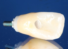 Abb. 27: Zur Ästhetik- und Funktionseinprobe wurden das PEKK-Abutment, die Laborschraube und die Zirkoniumdioxidkrone angeliefert.