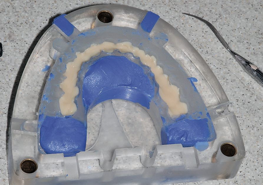 Abb. 36: Erste Dentinpressung – Überpressen des Kunststoffes in der Küvette.