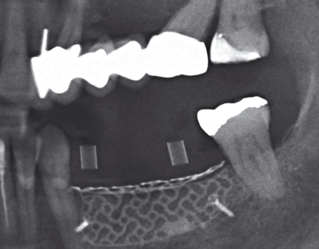 Abb. 64: Messaufnahme vor Implantation.