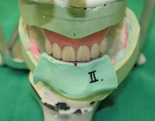 Abb. 22: Wie üblich werden zuerst die Oberkiefer-Frontzähne aufgestellt.