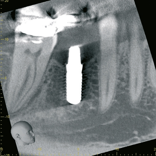 Abb. 27: Die Implantatposition im CT von lateral.