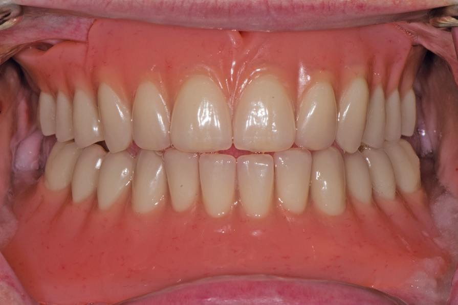 Abb. 32: Kontrolle der Exzentrik bei Protrusion.