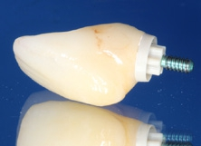 Abb. 28: Nach der Einprobe wurde das PEKK-Abutment silanisiert, die Krone geätzt und die einzelnen Komponenten wurden mit einem Hybridabutmentkleber definitiv verbunden.