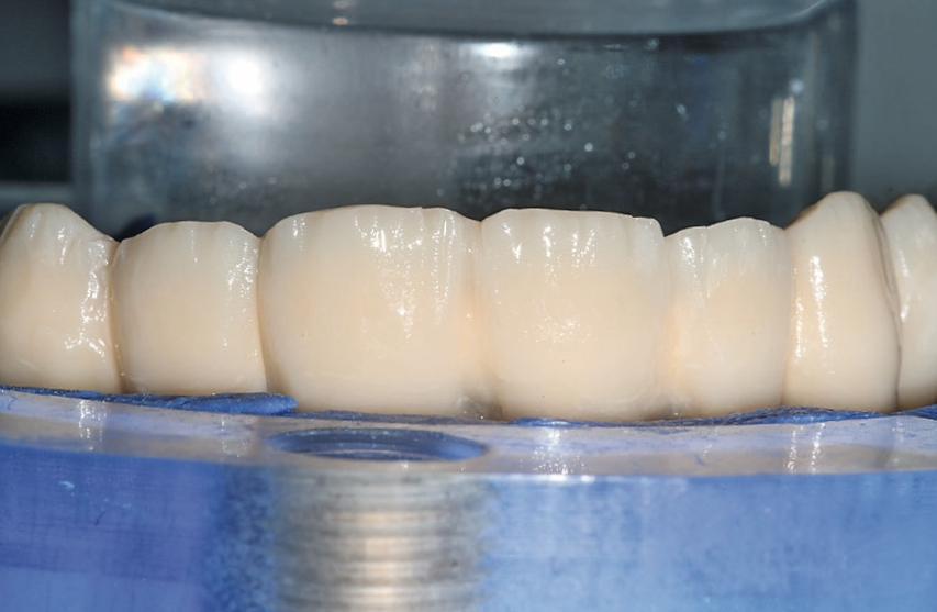 Abb. 37: Nach der ersten Dentinpressung folgt die Vorbereitung für die finale Schneidepressung.