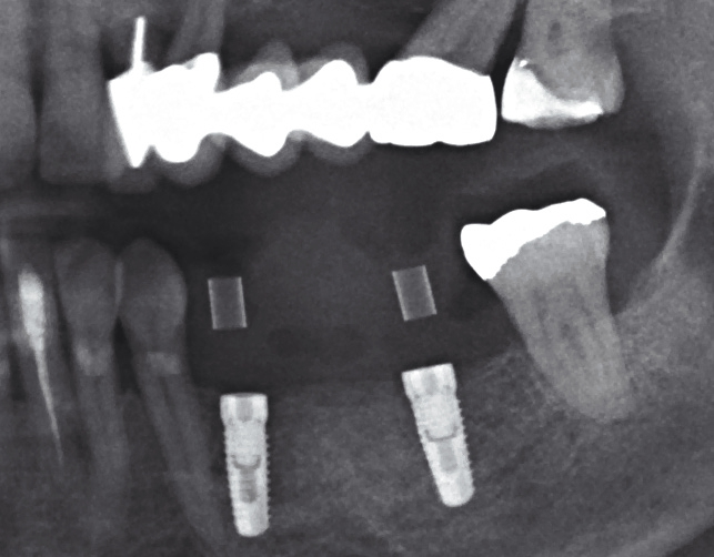 Abb. 65: Kontrollaufnahme nach Implantation.