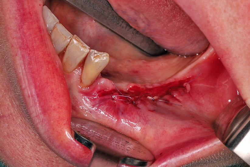 Abb. 28: Verbreiterung der keratinisierten Gingiva mittels Verschiebelappen.