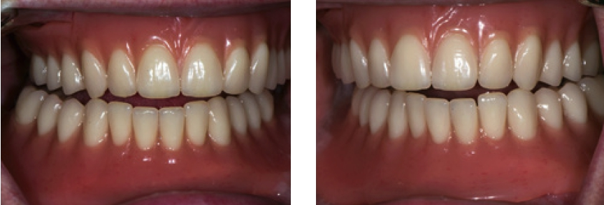 Abb. 30 u. 31: Kontrolle der Exzentrik bei Laterotrusion.