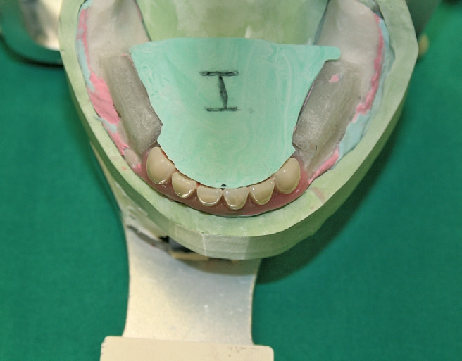 Abb. 23: Es folgt die Aufstellung der Unterkiefer-Front, unter Berücksichtigung des Zungenraumes.