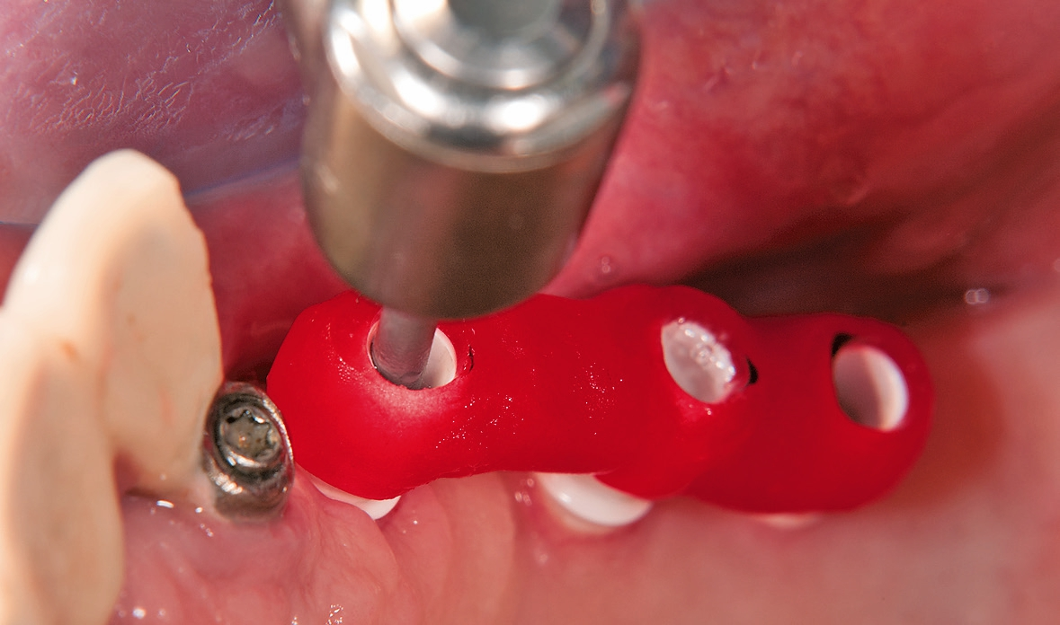 Abb. 28: Einschrauben der Abutments mit dem Einbringschlüssel.