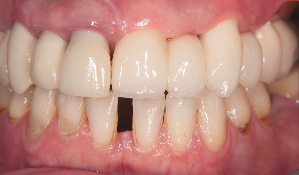 Abb. 28: Nach drei Wochen verheilte Gingiva.