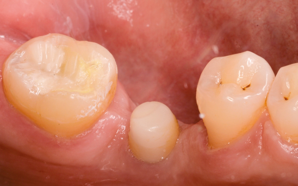 Abb. 28: Das ceramic.implant mit temp.cap nach acht Wochen Einheilzeit.