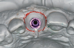 Abb. 27: Kontrolliert gestaltetes Emergenzprofil für die therapeutische Implantatrekonstruktion.