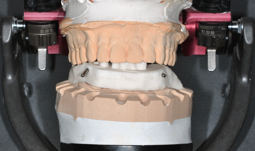 Abb. 29: Einartikulieren der Modelle mithilfe des Biss-Inserts.