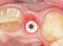 Abb. 29: Das individuell ausgeformte Weichgewebsprofil vor der definitiven Insertion der Implantatkrone.