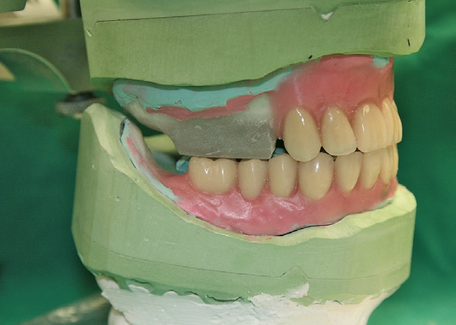 Abb. 24: Aufstellung der Unterkiefer-Seitenzähne.