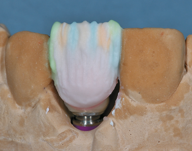 Abb. 27: Mesial und distal werden die Mamelon-Effekte noch mit Opakdentin verstärkt.